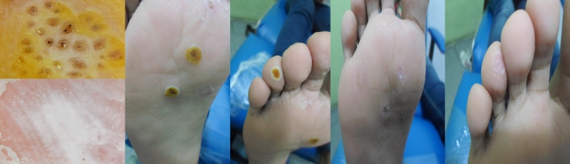 Verruga plantar Podologo Santo Domingo